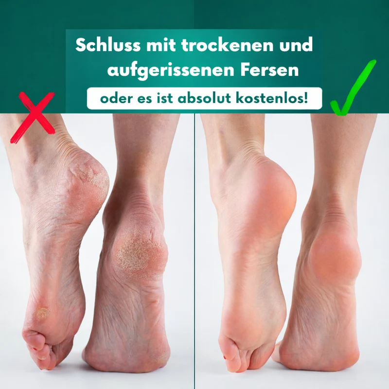 SilkySole™ Profi Hornhautentferner – Ideal für Zuhause