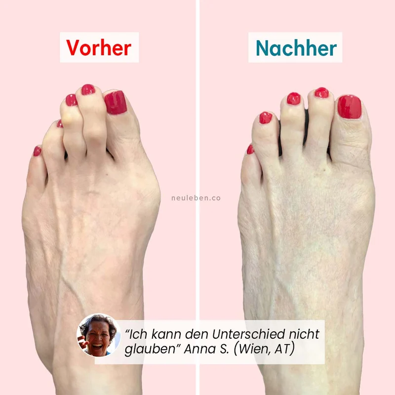 PerfectToes - Natürlicher Zehenkorrektor