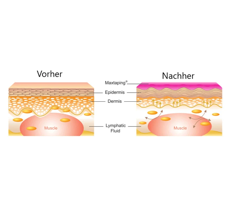 Kinesiologisches Tape Sport Therapie Muskel Unterstützung